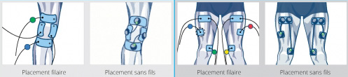 placement electrodes tendinopathie rotulienne genou
